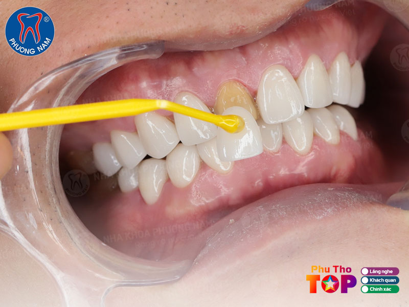 Nha-khoa-phuong-nam-phuthotoplist