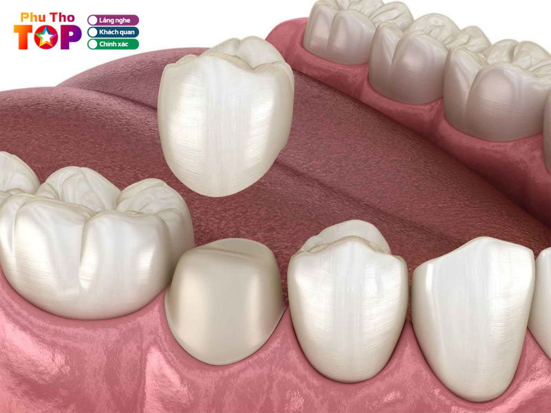 Tieu-chi-lua-chon-dia-chi-boc-rang-su-uy-tin-phuthotoplist