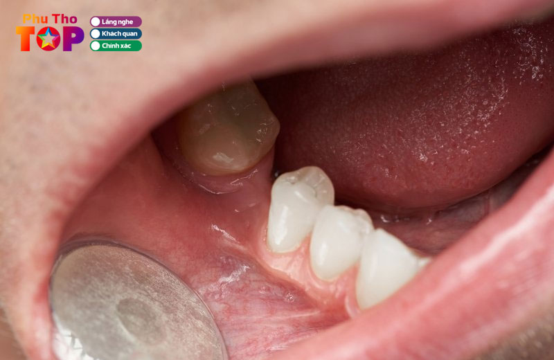 Nhu-cau-cham-soc-rang-mieng-ngay-cang-duoc-quan-tam-phuthotoplist