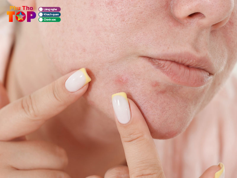 Kinh-nghiem-chon-dia-chi-tri-tham-do-mun-phu-tho-phuthotoplist