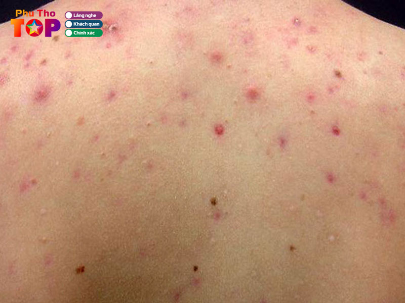 Luu-y-khi-chon-dia-chi-tri-viem-nang-long-phu-tho-phuthotoplist