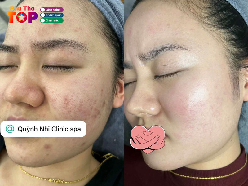 Quynh-nhi-clinic-spa-phuthotoplist
