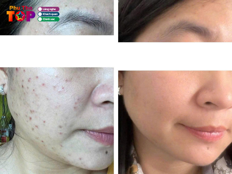 Sen-indochine-spa-phuthotoplist