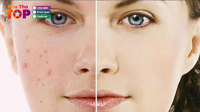 Top-10-dia-chi-tri-tham-do-mun-phu-tho-co-lieu-trinh-ro-rang-phuthotoplist