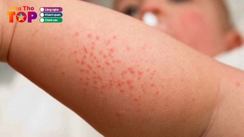 Top-5-dia-chi-tri-viem-nang-long-phu-tho-an-toan-hieu-qua-lau-dai-phuthotoplist