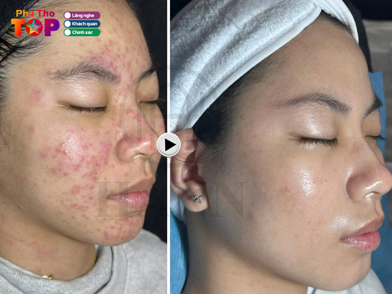 Hann-skinlab-phuthotoplist
